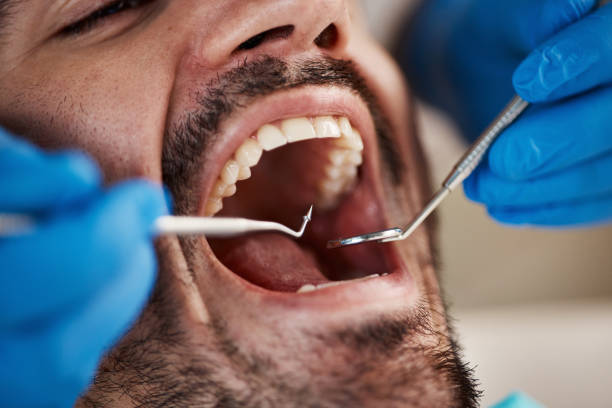 Best Knocked-Out Tooth Emergency  in Lake Shore, MD